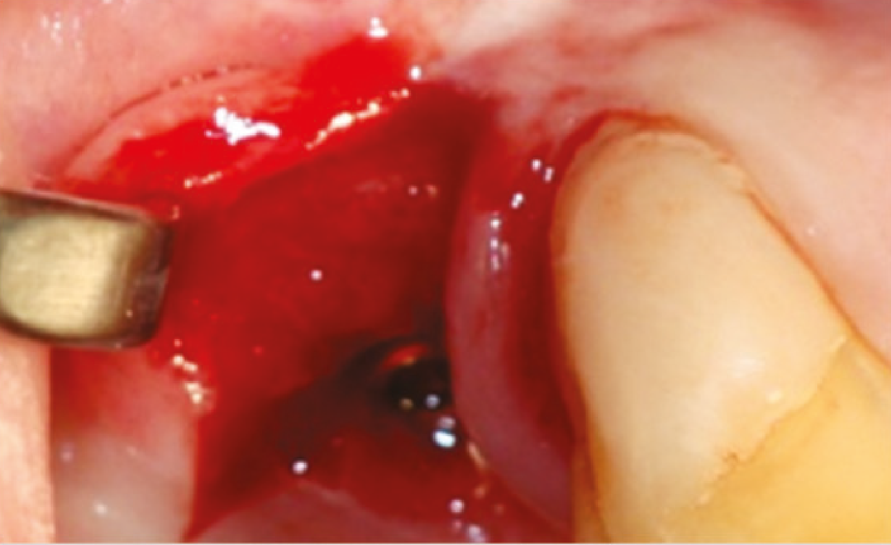 Bioresorbierbarkeit