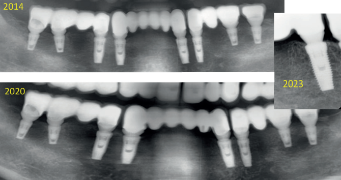 Implante dental 2