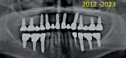 Implante dental
