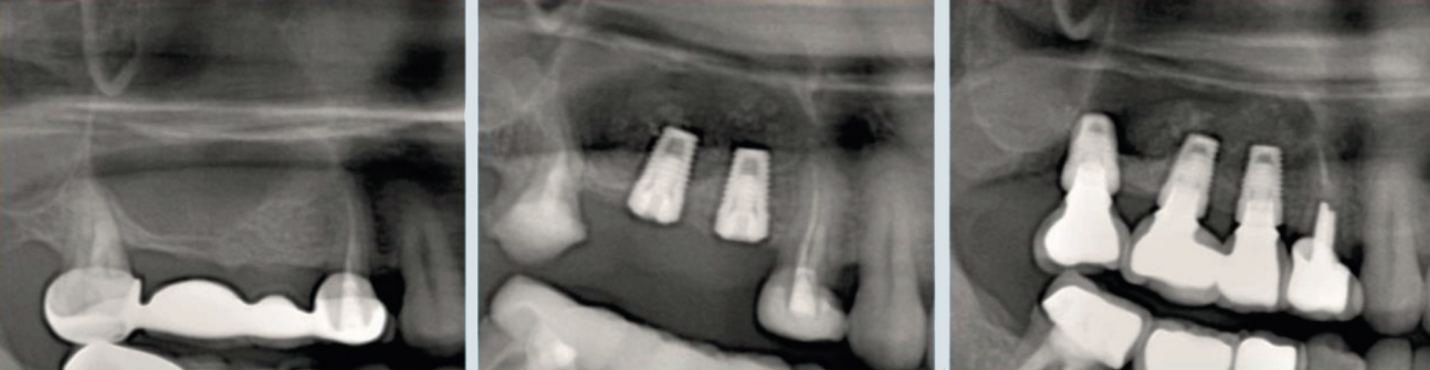 Elevación lateral del seno maxilar + implantación inmediata